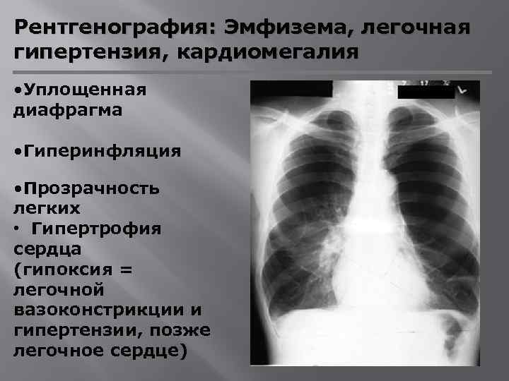 Рентгенография: Эмфизема, легочная гипертензия, кардиомегалия • Уплощенная диафрагма • Гиперинфляция • Прозрачность легких •