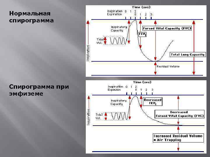 Что дает спирограмма. Спирограмма физиология расшифровка. Спирограмма легких физиология. Спирография анализ спирограммы. Показатели спирограммы физиология.