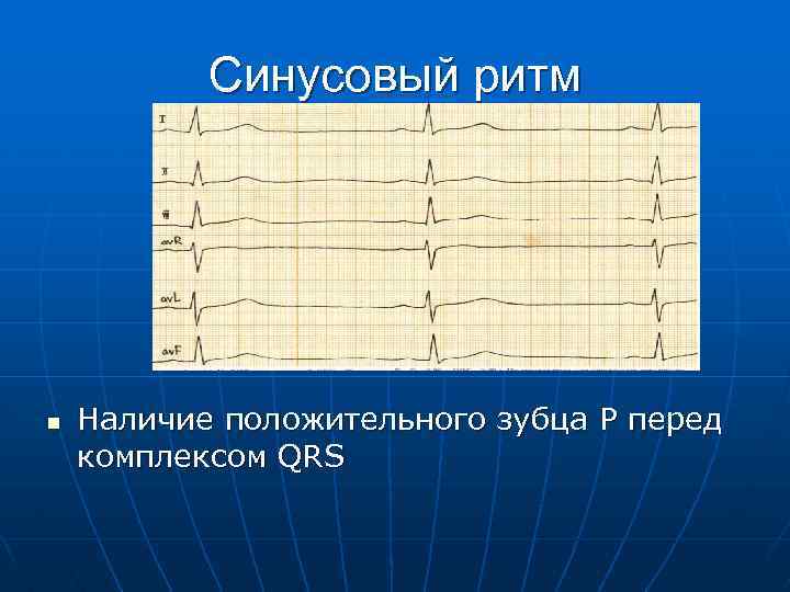 Синусовый ритм n Наличие положительного зубца Р перед комплексом QRS 