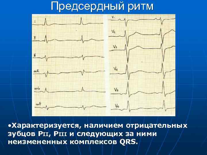 Предсердный ритм • Характеризуется, наличием отрицательных зубцов РII, РIII и следующих за ними неизмененных