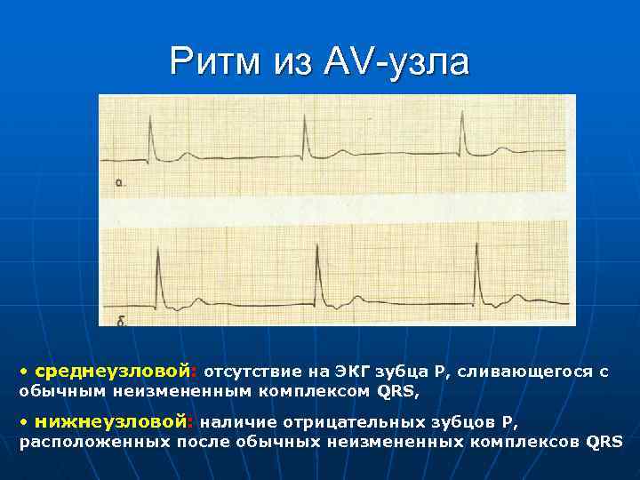 Ритм из AV-узла • среднеузловой: отсутствие на ЭКГ зубца Р, сливающегося с обычным неизмененным