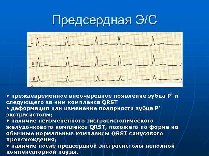 Предсердная Э/С • преждевременное внеочередное появление зубца Р' и следующего за ним комплекса QRST