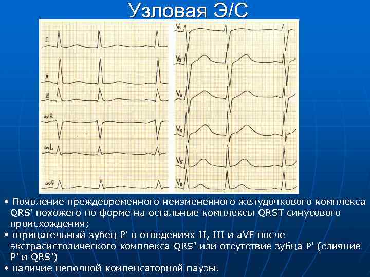 Узловая Э/С • Появление преждевременного неизмененного желудочкового комплекса QRS' похожего по форме на остальные