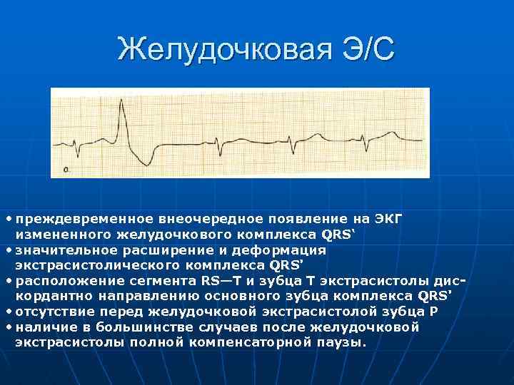 Желудочковая Э/С • преждевременное внеочередное появление на ЭКГ измененного желудочкового комплекса QRS‘ • значительное