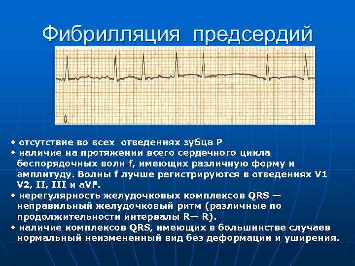 Фибрилляция предсердий • отсутствие во всех отведениях зубца P • наличие на протяжении всего