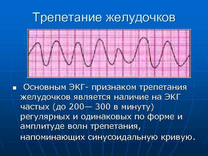 Трепетание желудочков n Основным ЭКГ- признаком трепетания желудочков является наличие на ЭКГ частых (до