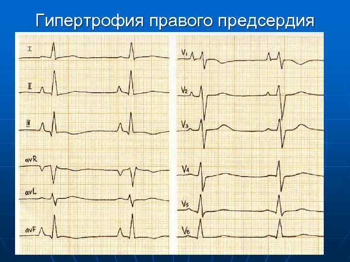 Гипертрофия правого предсердия 