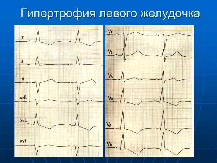 Гипертрофия левого желудочка 