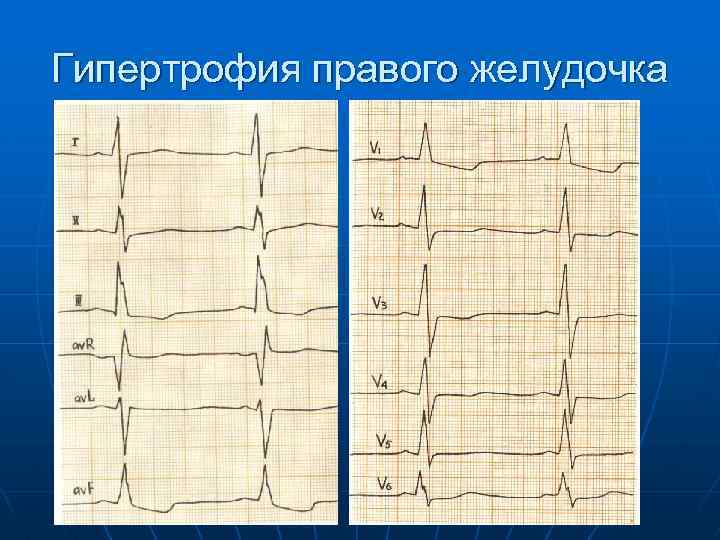 Гипертрофия правого желудочка 