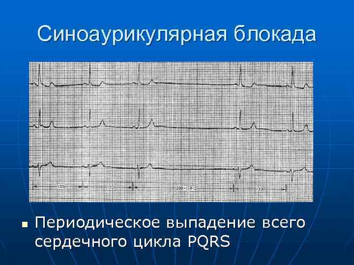 Синоаурикулярная блокада n Периодическое выпадение всего сердечного цикла PQRS 