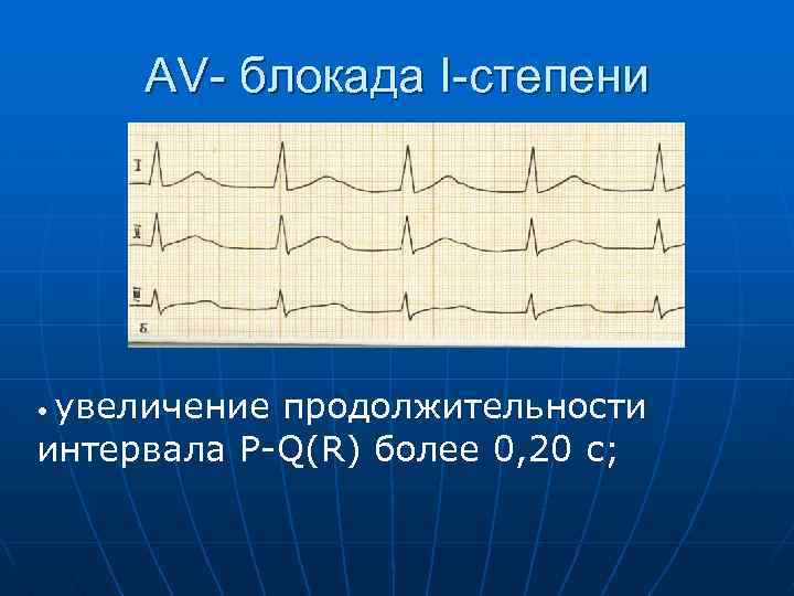 AV- блокада I-степени увеличение продолжительности интервала P-Q(R) более 0, 20 с; • 