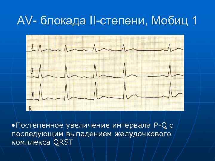 AV- блокада II-степени, Мобиц 1 • Постепенное увеличение интервала P-Q c последующим выпадением желудочкового