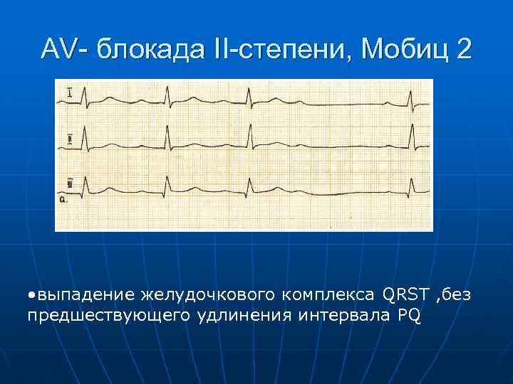 AV- блокада II-степени, Мобиц 2 • выпадение желудочкового комплекса QRST , без предшествующего удлинения