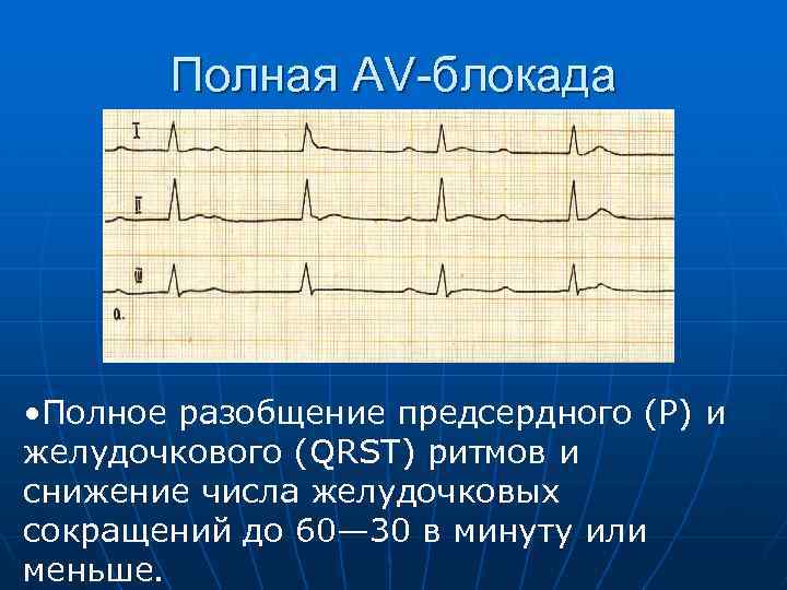 Полная AV-блокада • Полное разобщение предсердного (Р) и желудочкового (QRST) ритмов и снижение числа