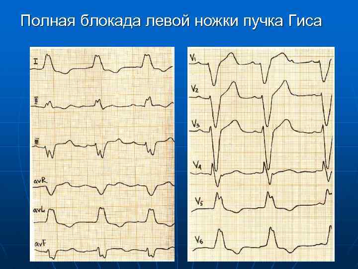 Полная блокада левой ножки пучка Гиса 