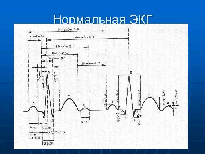 Нормальная ЭКГ 