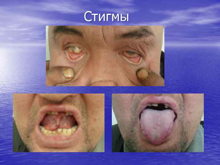 Стигмы 