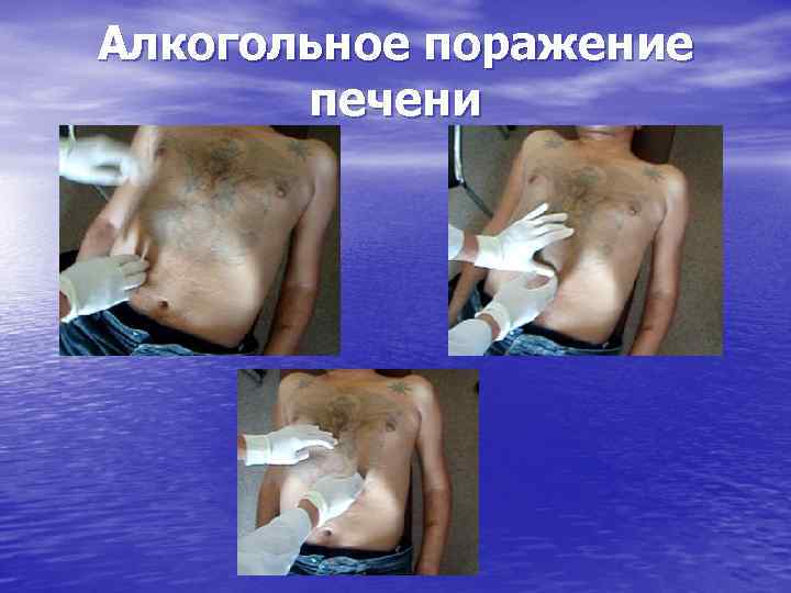 Алкогольное поражение печени 