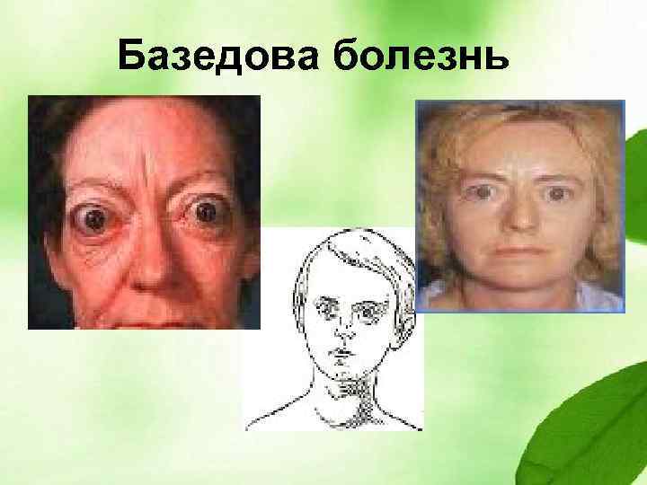 Базедова болезнь 