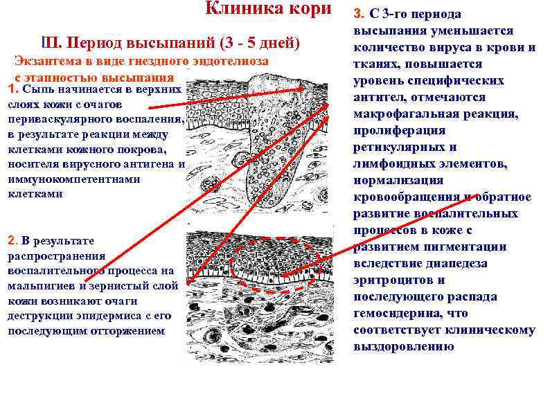 Клиника кори III. Период высыпаний (3 - 5 дней) Экзантема в виде гнездного эндотелиоза