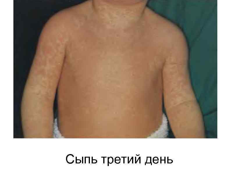 Сыпь третий день 