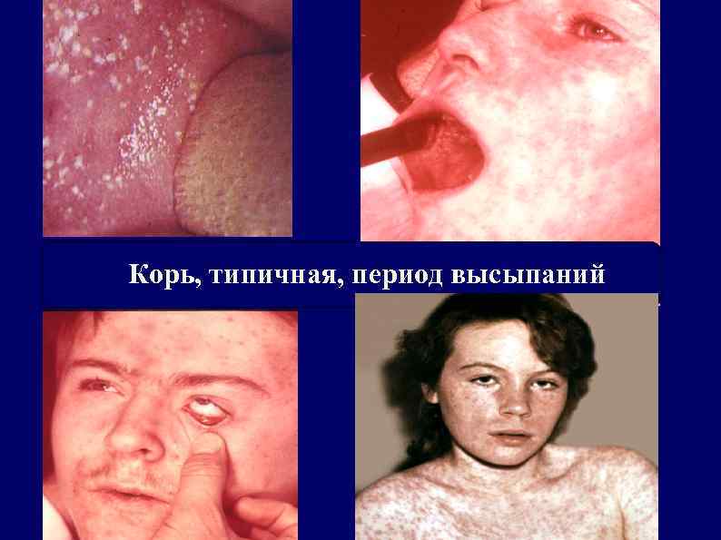 Корь, типичная, период высыпаний 