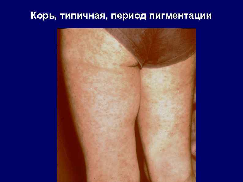 Корь, типичная, период пигментации 