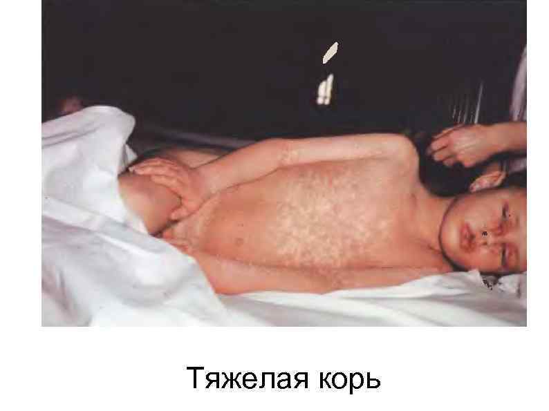 Тяжелая корь 