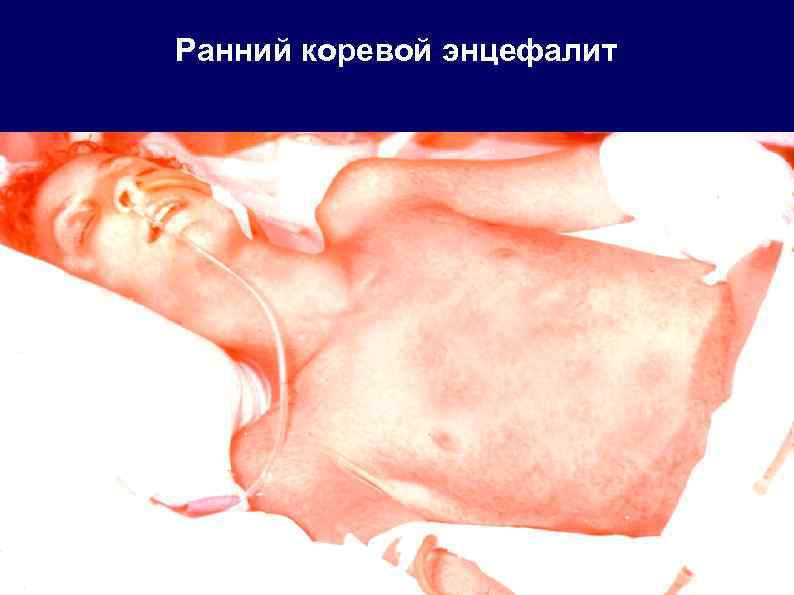 Ранний коревой энцефалит 