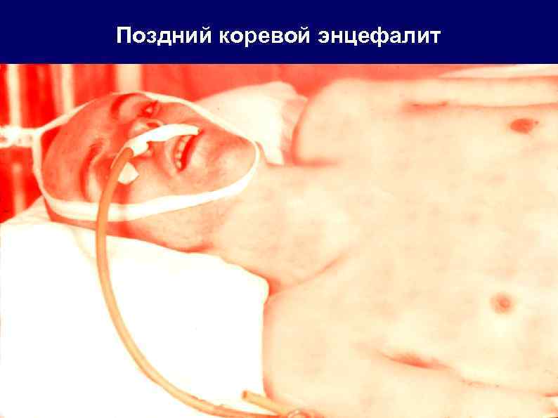 Поздний коревой энцефалит 