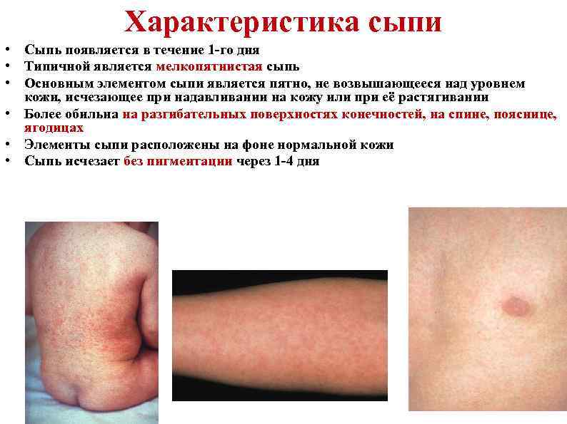 Характеристика сыпи • Сыпь появляется в течение 1 -го дня • Типичной является мелкопятнистая