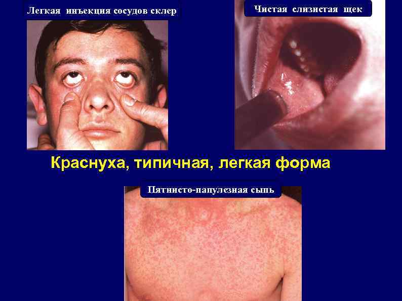 Легкая инъекция сосудов склер Чистая слизистая щек Краснуха, типичная, легкая форма Пятнисто-папулезная сыпь 