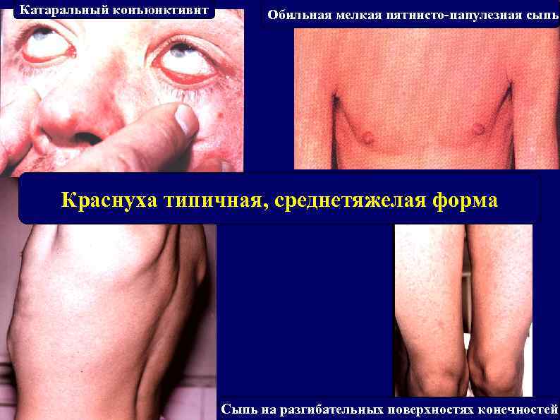 Катаральный конъюнктивит Обильная мелкая пятнисто-папулезная сыпь Краснуха типичная, среднетяжелая форма Сыпь на разгибательных поверхностях