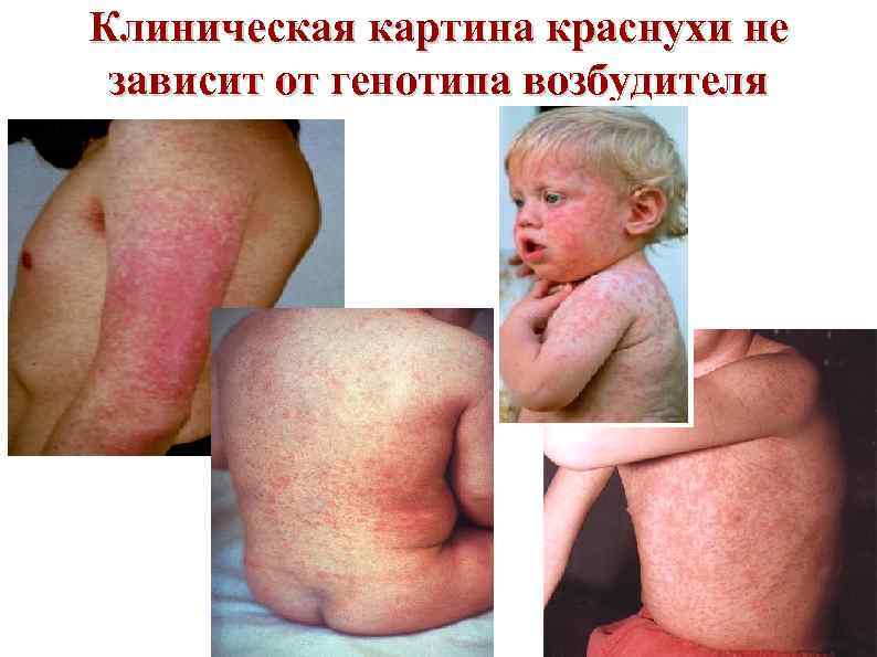 Клиническая картина краснухи не зависит от генотипа возбудителя 