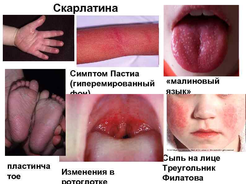 Скарлатина Симптом Пастиа (гиперемированный фон) пластинча тое Изменения в «малиновый язык» Сыпь на лице