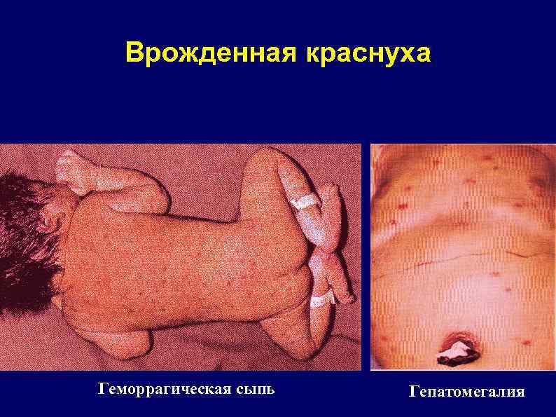 Врожденная краснуха Геморрагическая сыпь Гепатомегалия 