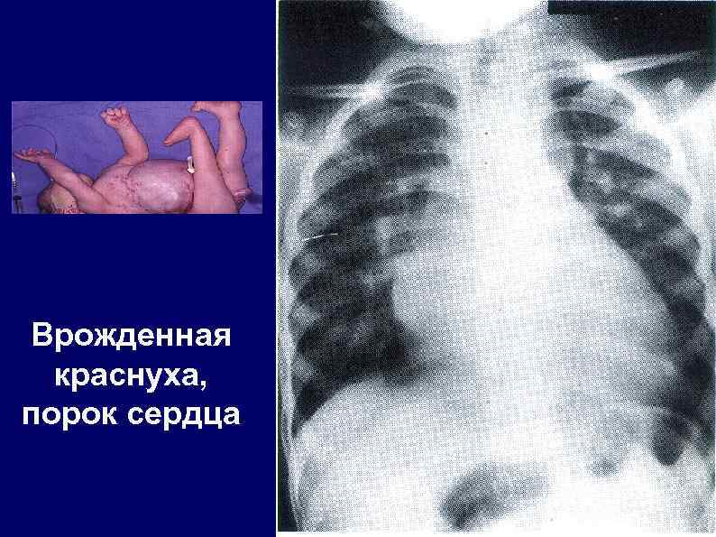 Врожденная краснуха, порок сердца 