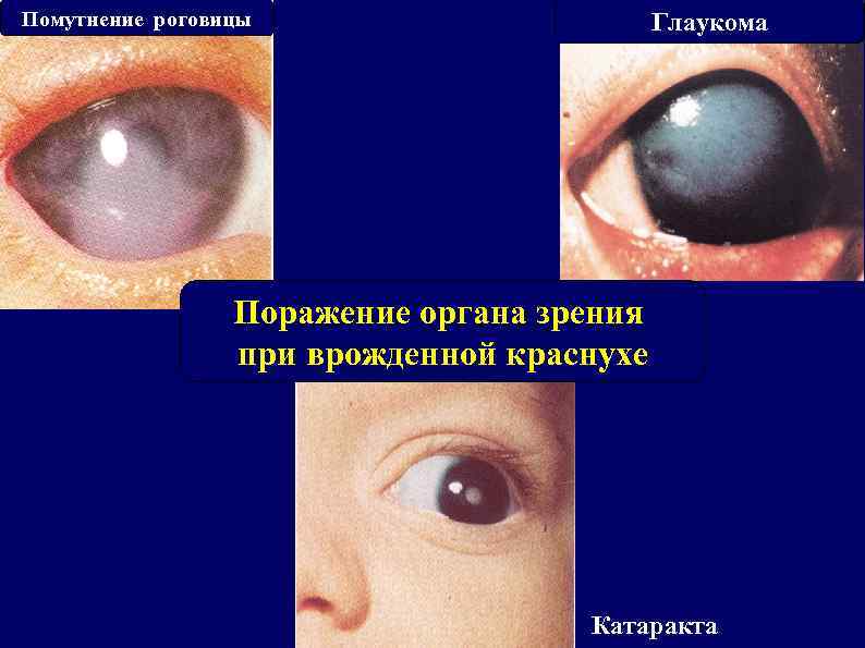 Помутнение роговицы Глаукома Поражение органа зрения при врожденной краснухе Катаракта 