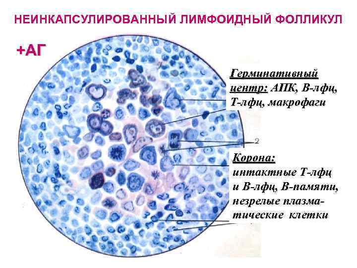 НЕИНКАПСУЛИРОВАННЫЙ ЛИМФОИДНЫЙ ФОЛЛИКУЛ +АГ Герминативный центр: АПК, В-лфц, Т-лфц, макрофаги Корона: интактные Т-лфц и