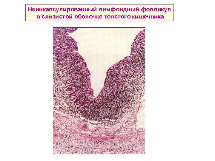 Неинкапсулированный лимфоидный фолликул в слизистой оболочке толстого кишечника 