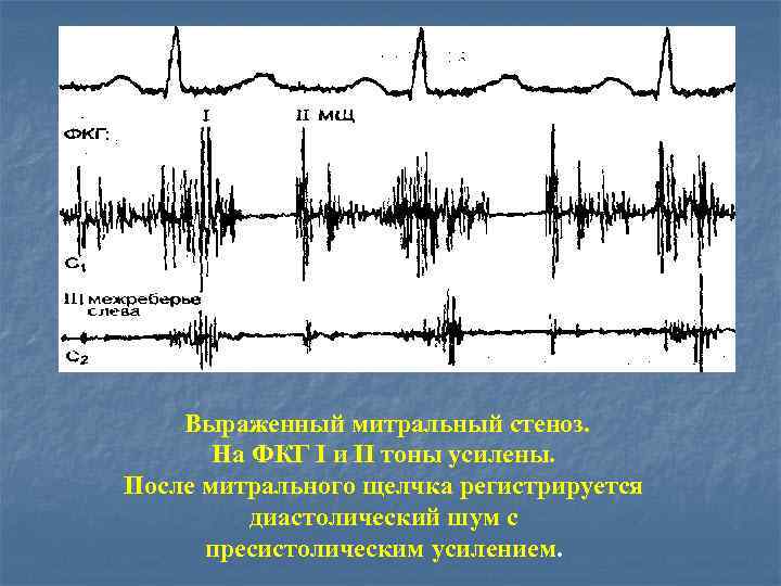 Выраженный митральный стеноз. На ФКГ I и II тоны усилены. После митрального щелчка регистрируется