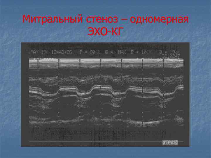 Митральный стеноз – одномерная ЭХО КГ 