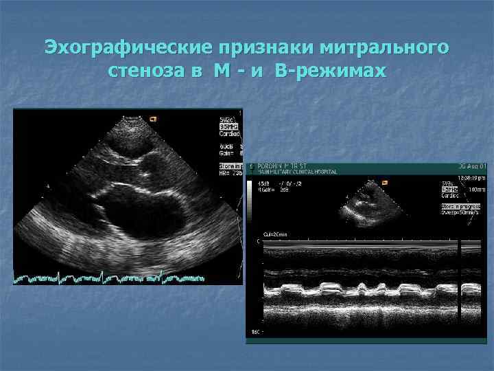 Эхографические признаки митрального стеноза в М и В режимах 