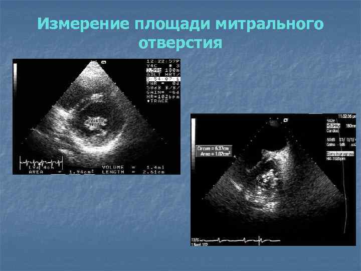 Измерение площади митрального отверстия 