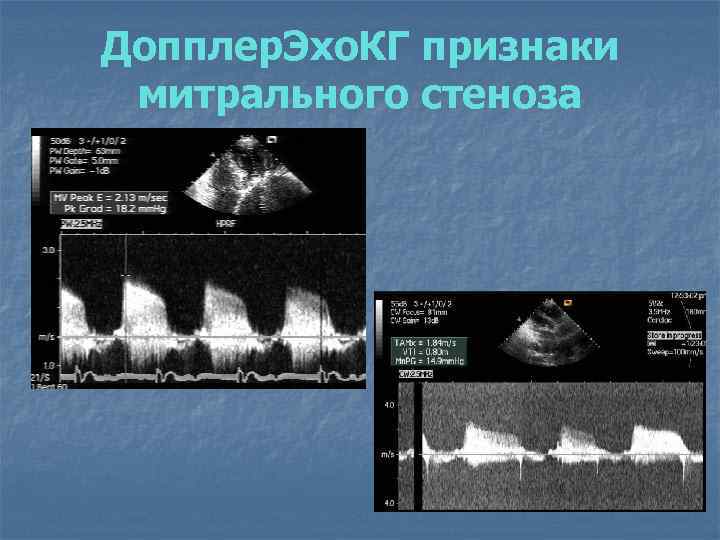 Допплер. Эхо. КГ признаки митрального стеноза 