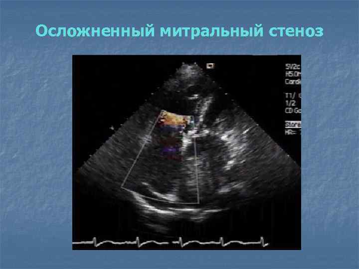 Осложненный митральный стеноз 
