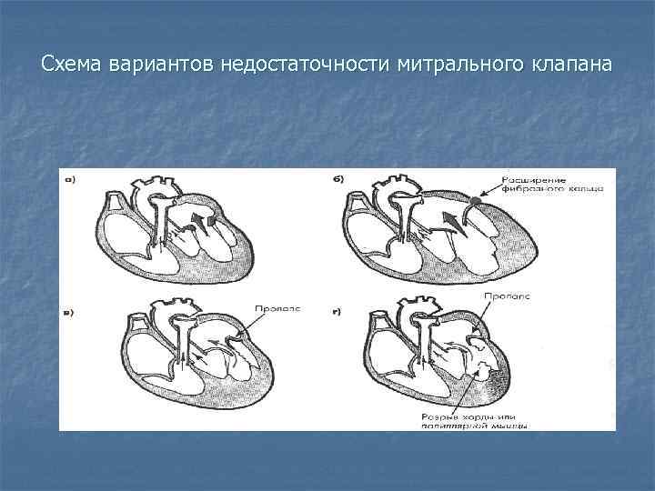 Схема вариантов недостаточности митрального клапана 