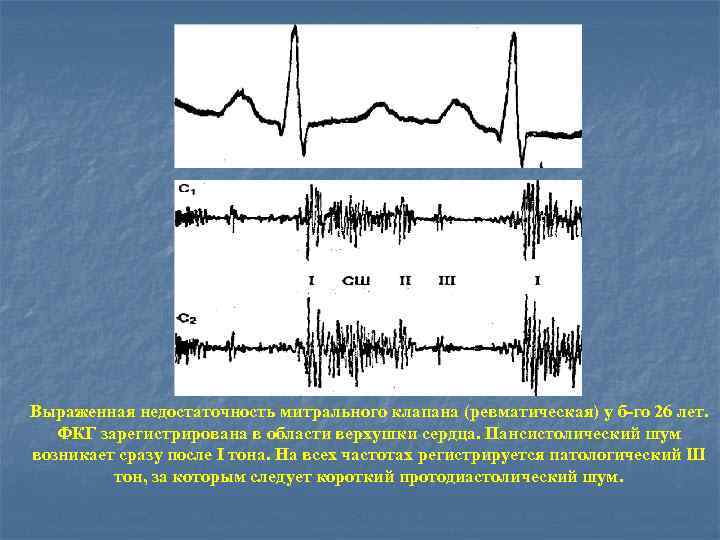 Выраженная недостаточность митрального клапана (ревматическая) у б-го 26 лет. ФКГ зарегистрирована в области верхушки