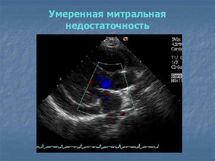 Умеренная митральная недостаточность 