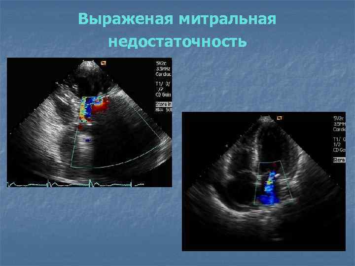 Выраженая митральная недостаточность 